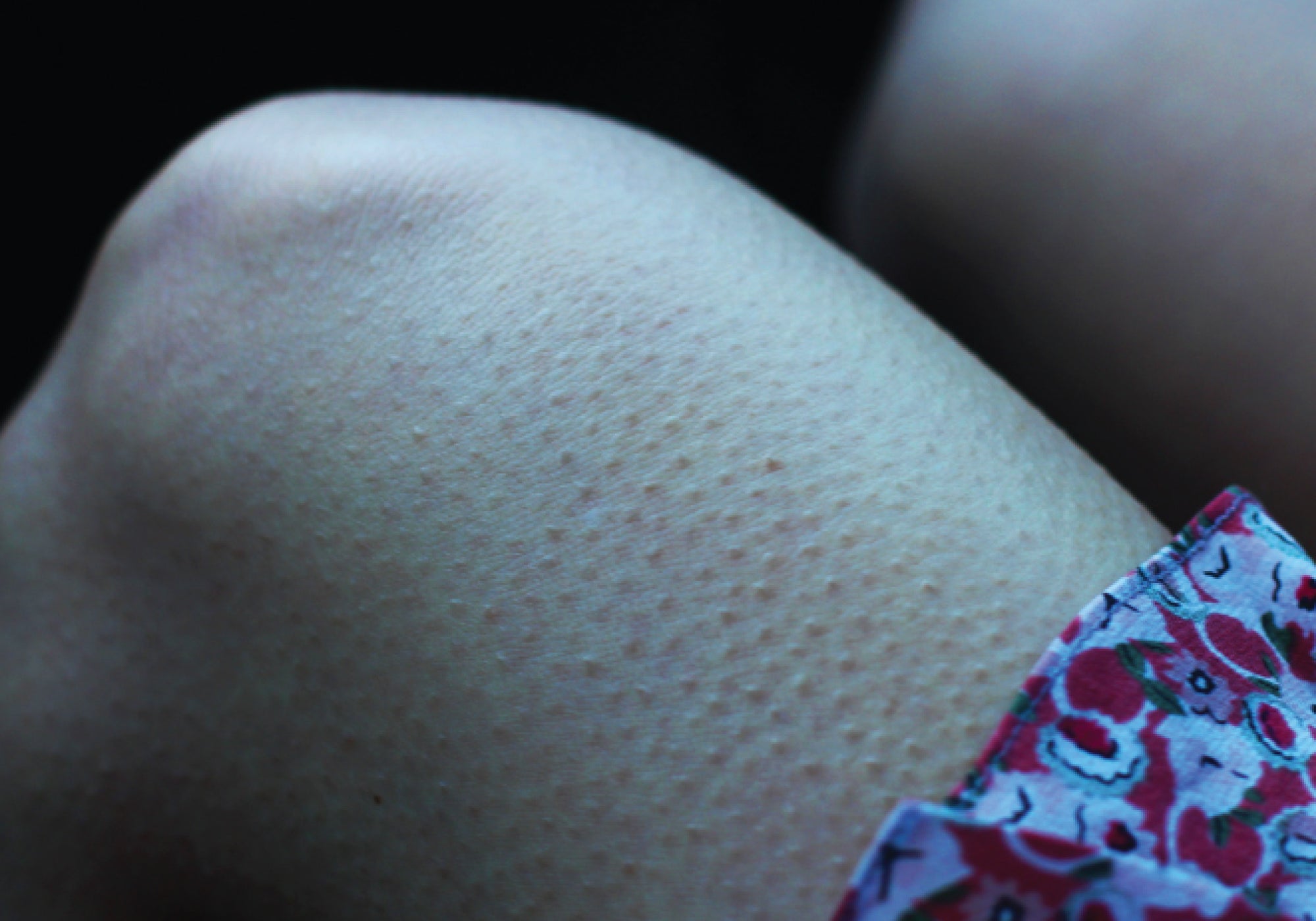 Help, I Have Chicken Skin! What Is Keratosis Pilaris & What Can I Do About It?