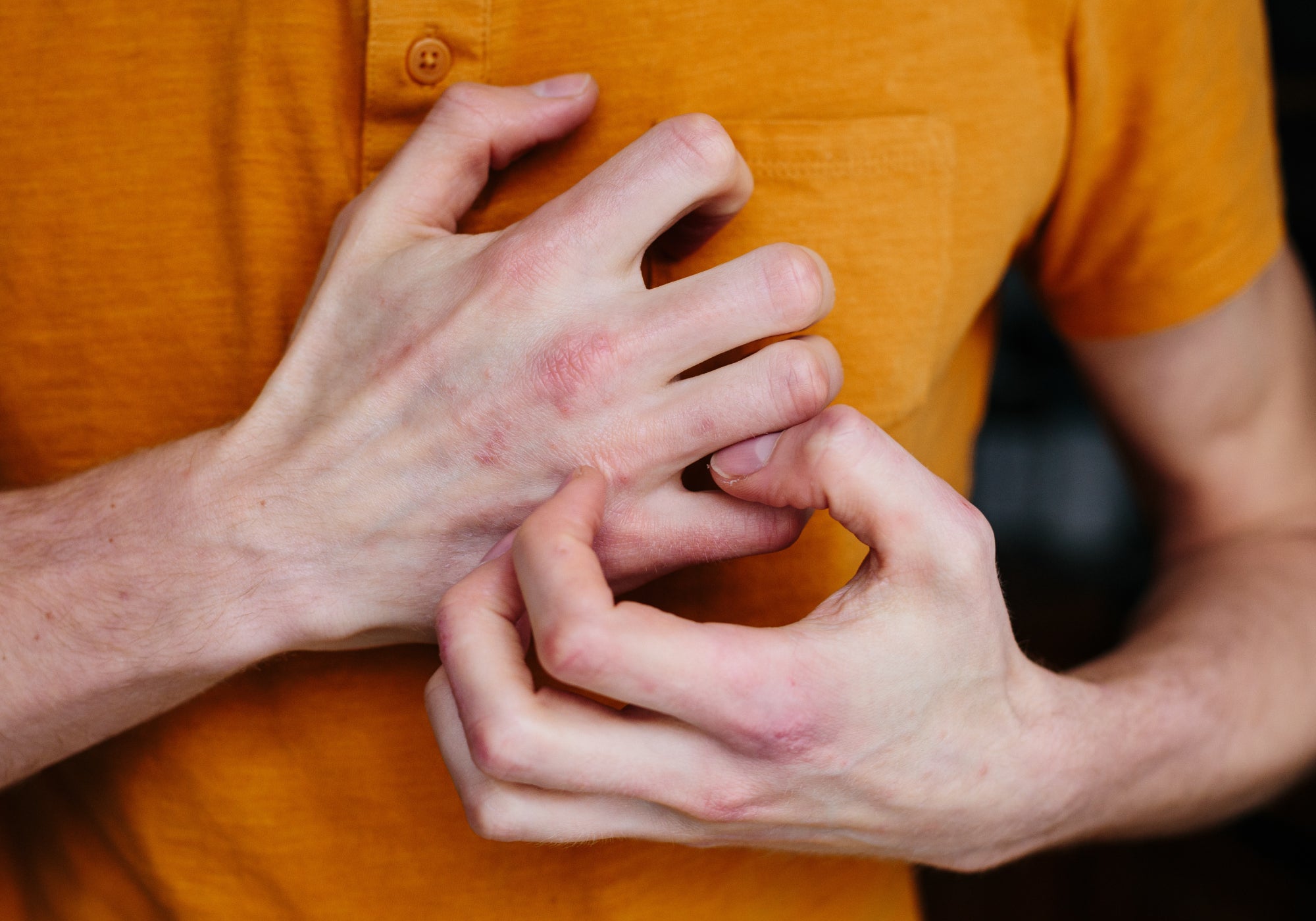 Why Does Diabetes Cause Dry Skin?