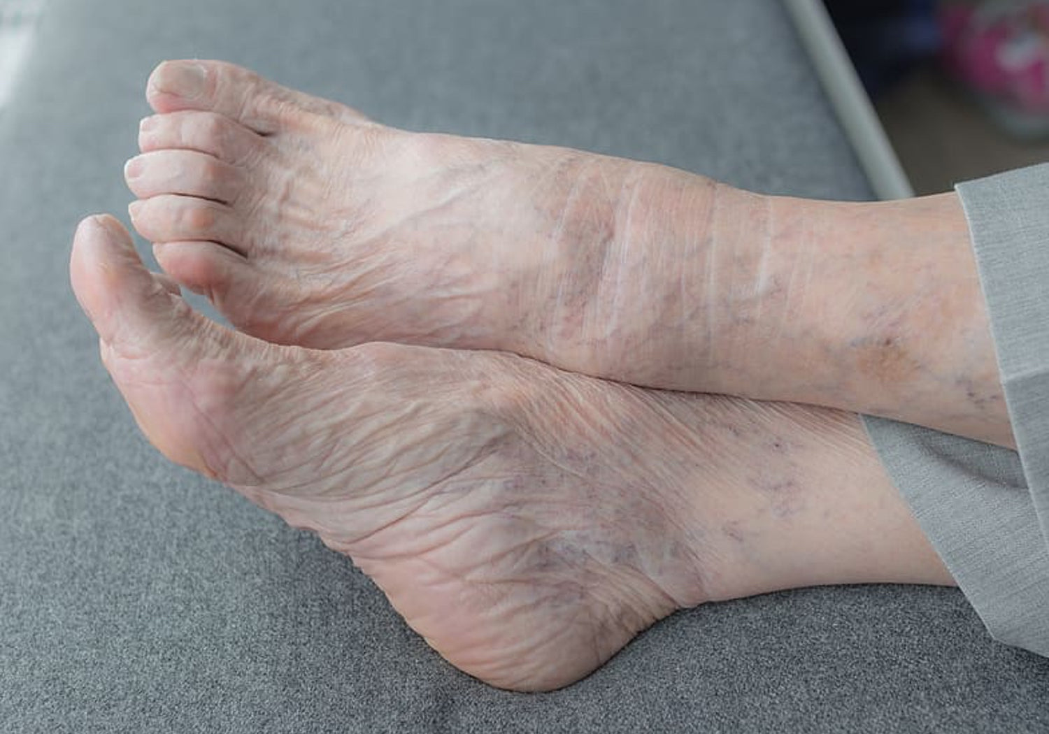Is Varicose Eczema Curable?