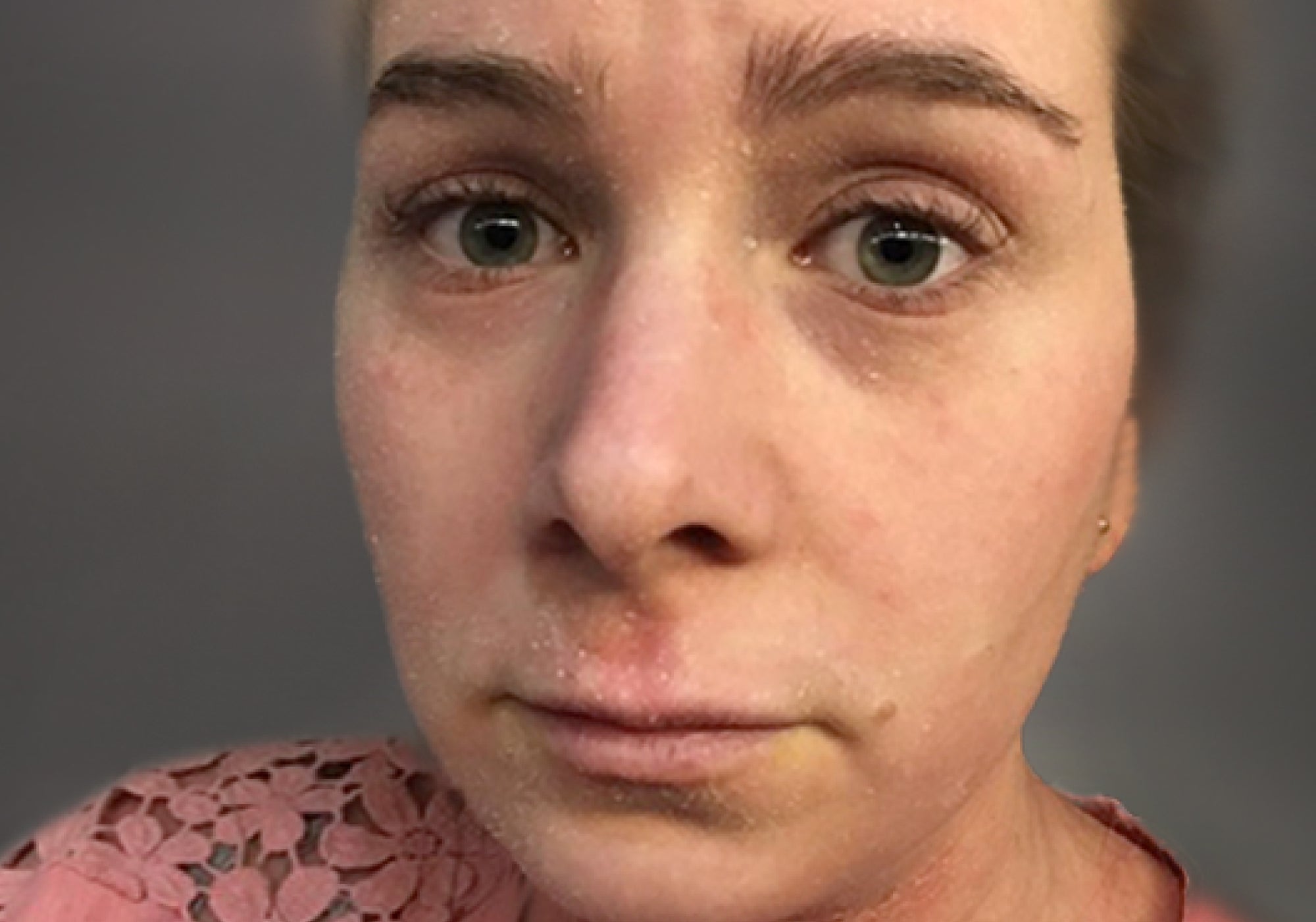 How To Deal With Topical Steroid Withdrawal Flaking
