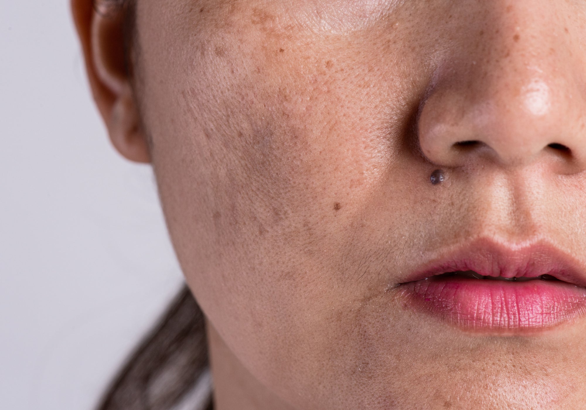 What Causes Post-Inflammatory Hyperpigmentation?