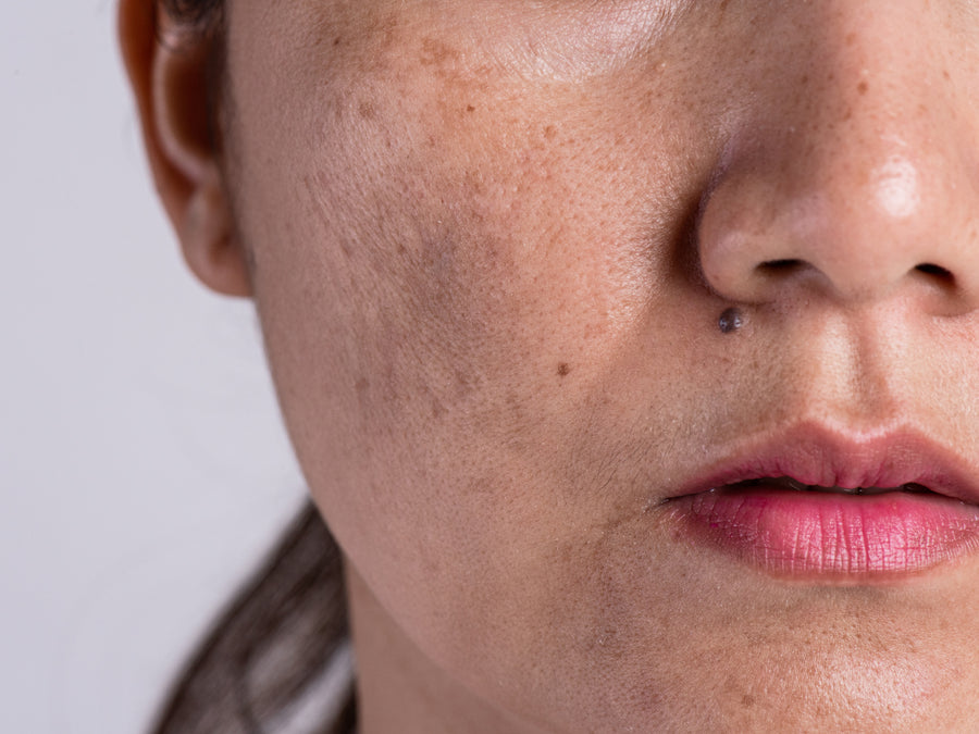 What Causes Post-Inflammatory Hyperpigmentation?