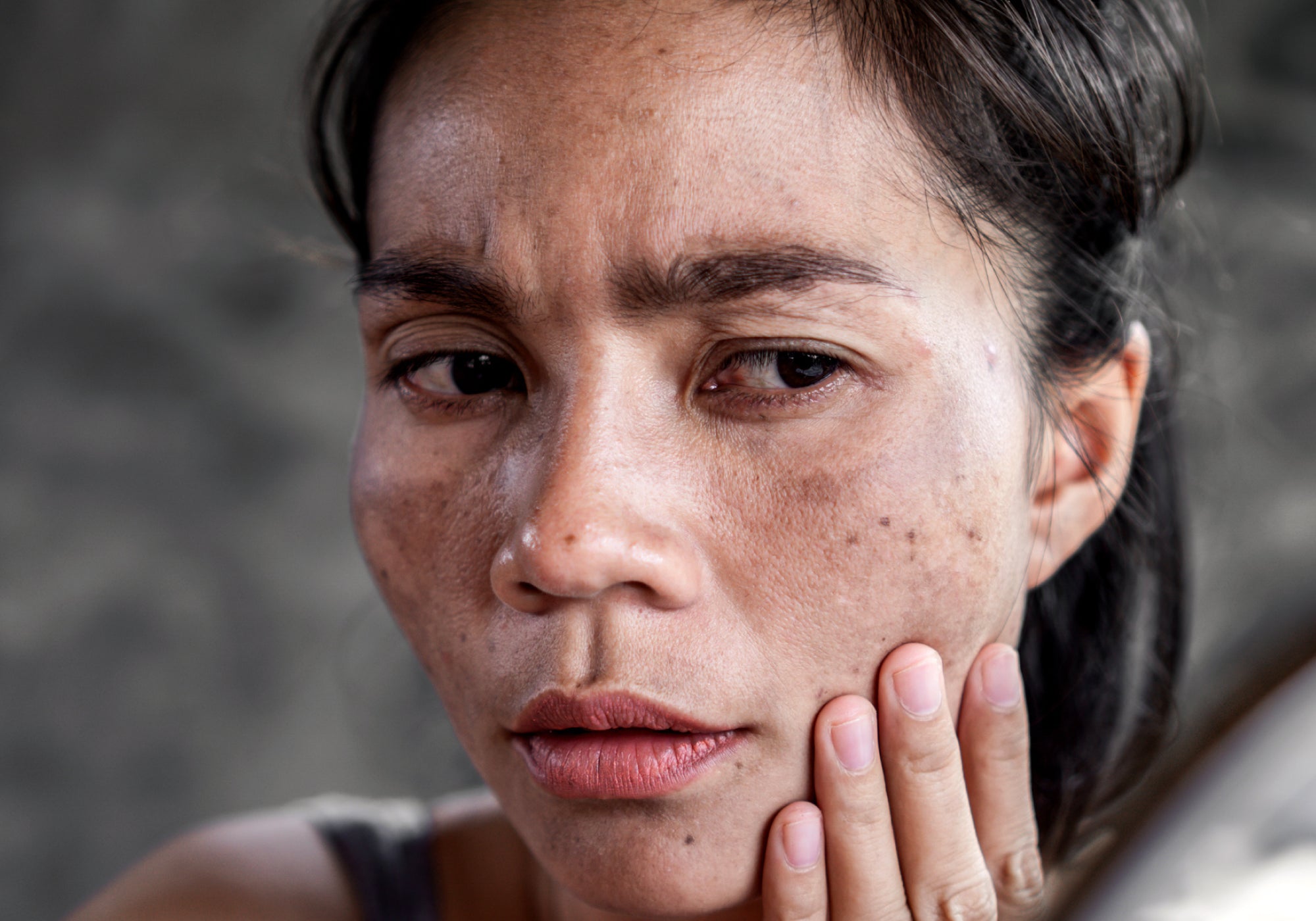 Is Post-Inflammatory Hyperpigmentation Permanent?
