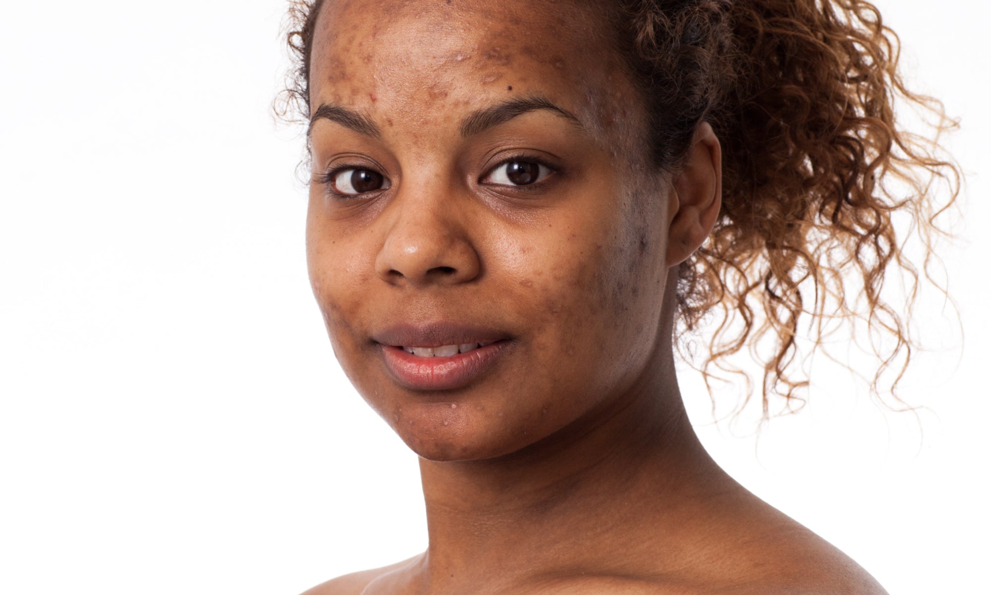 What Does Post-Inflammatory Hyperpigmentation Look Like?