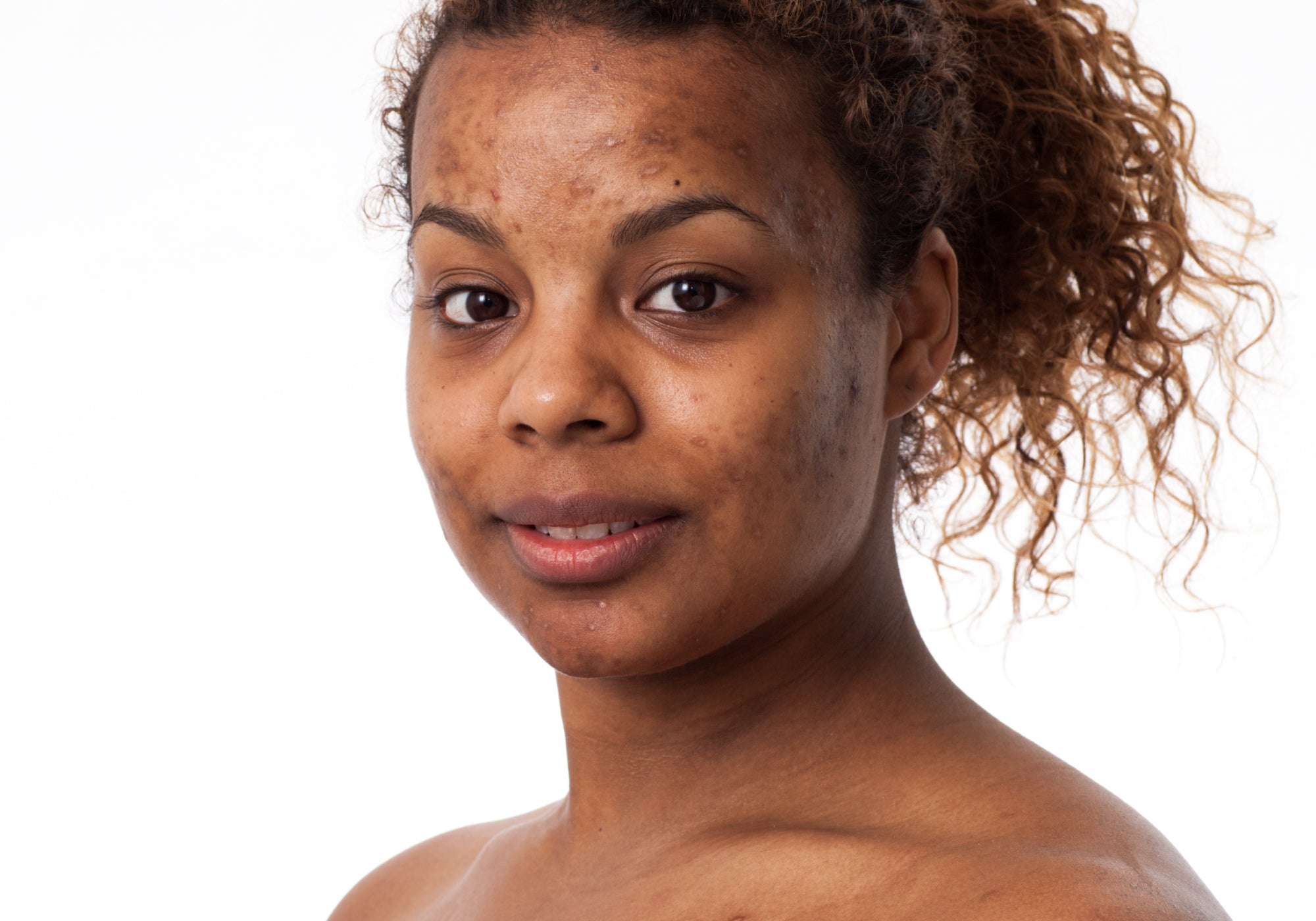 What Does Post-Inflammatory Hyperpigmentation Look Like?