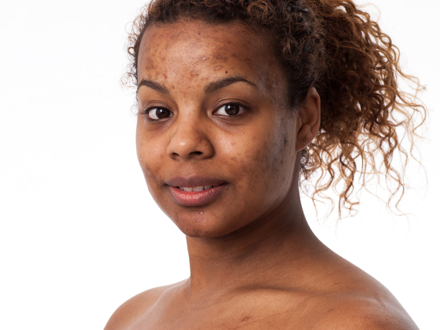 What Does Post-Inflammatory Hyperpigmentation Look Like?