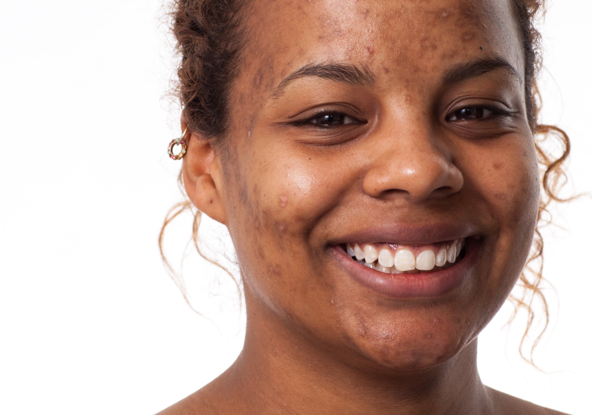 How To Get Rid Of Post-Inflammatory Hyperpigmentation 