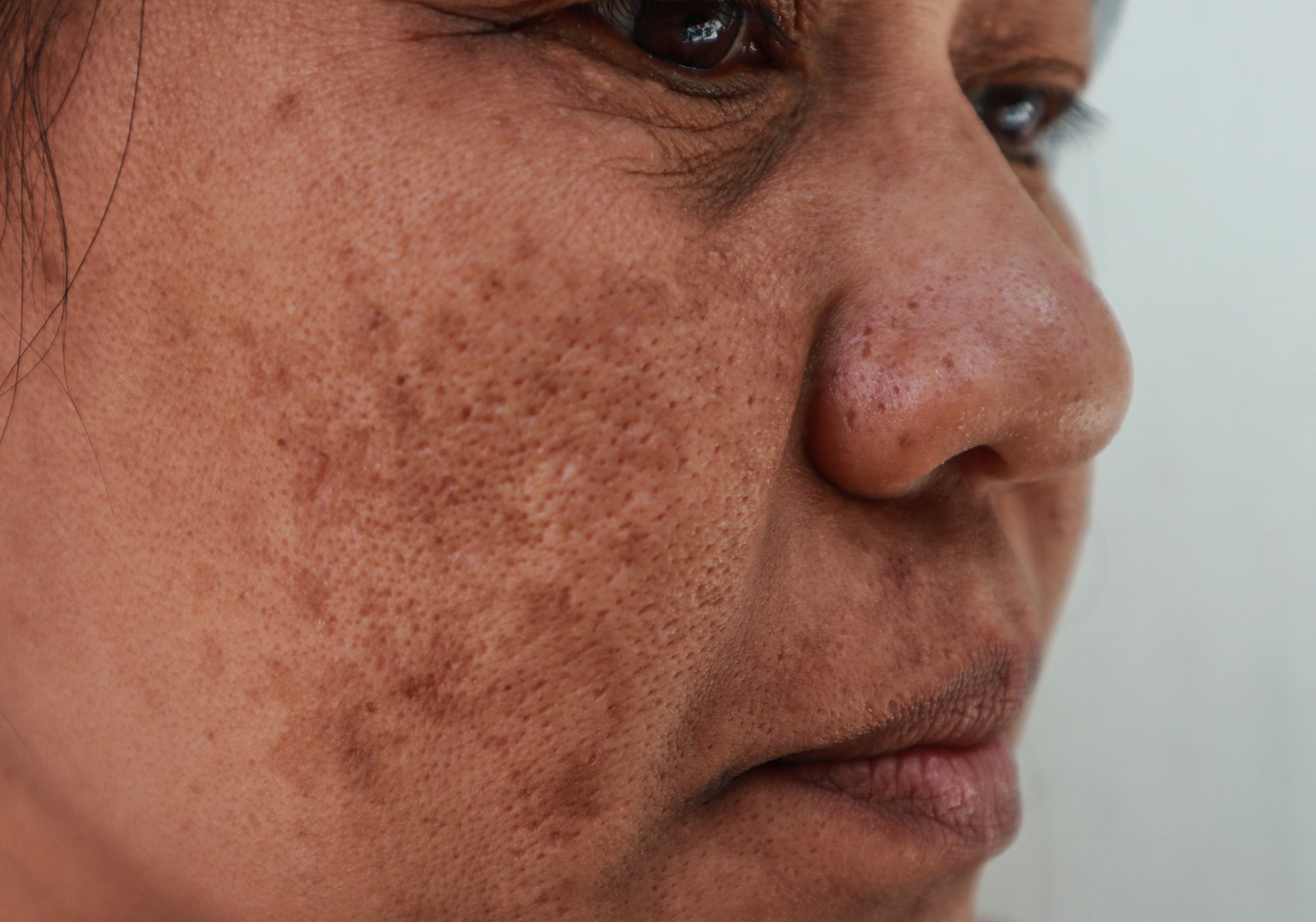Is There A Natural Treatment For Post-Inflammatory Hyperpigmentation That Actually Works?