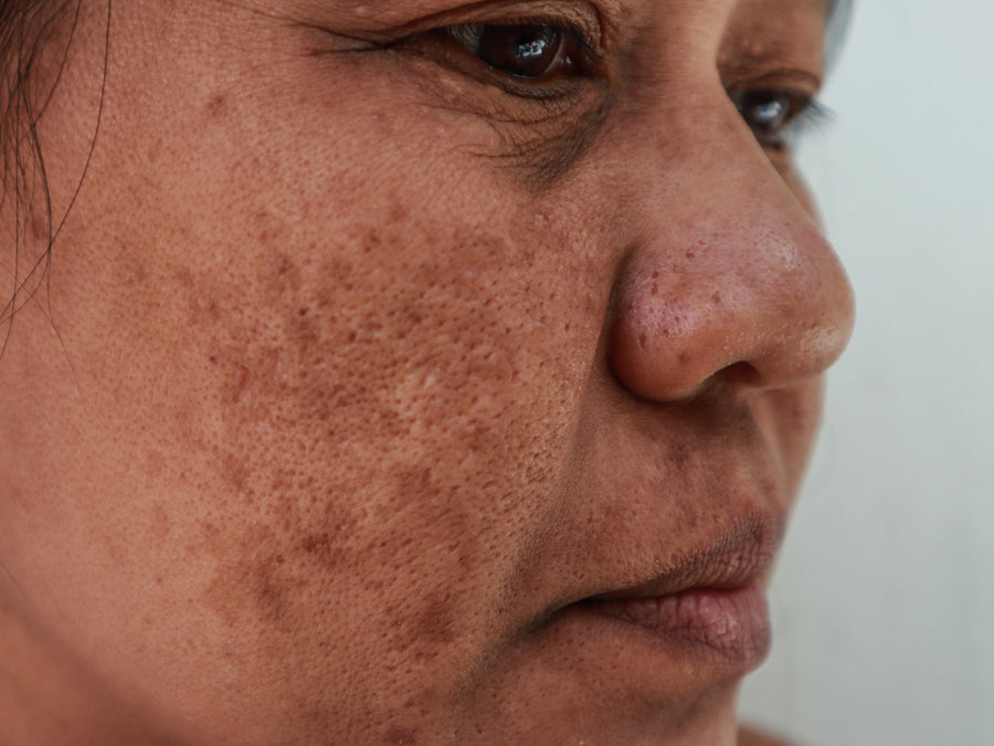 Is There A Natural Treatment For Post-Inflammatory Hyperpigmentation That Actually Works?
