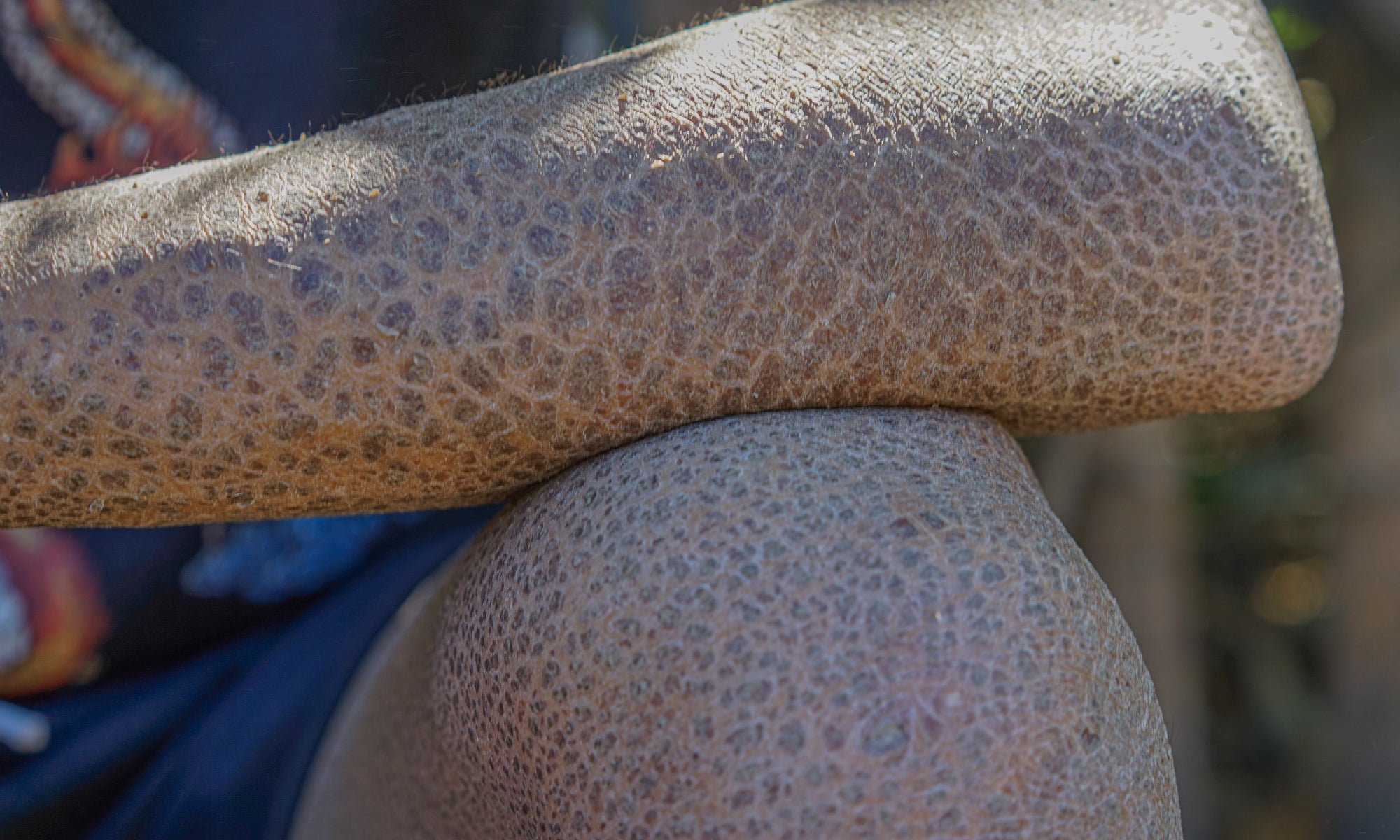 What Causes Ichthyosis Skin Disorder?