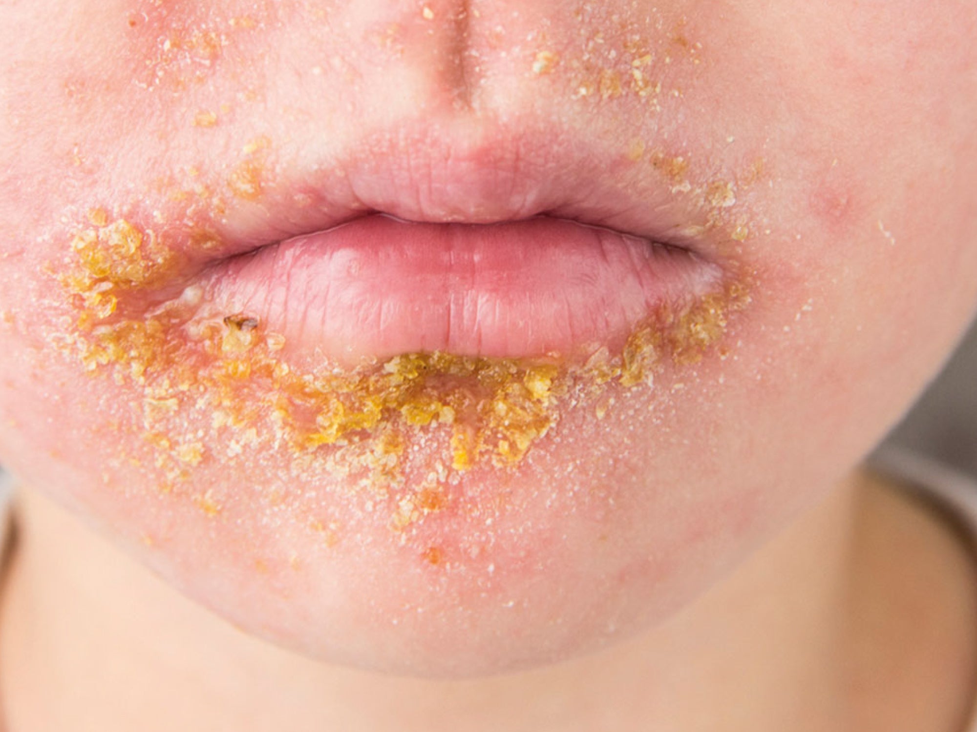 What Is The Difference Between Perioral Dermatitis And Impetigo? – Dr Qaisar Ahmed