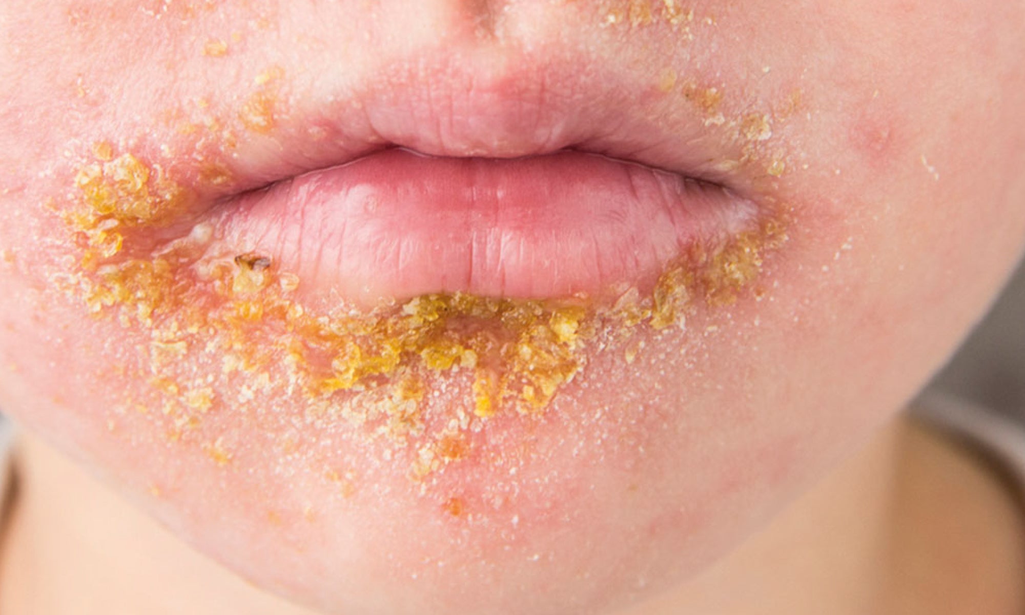 What Is The Difference Between Perioral Dermatitis And Impetigo?