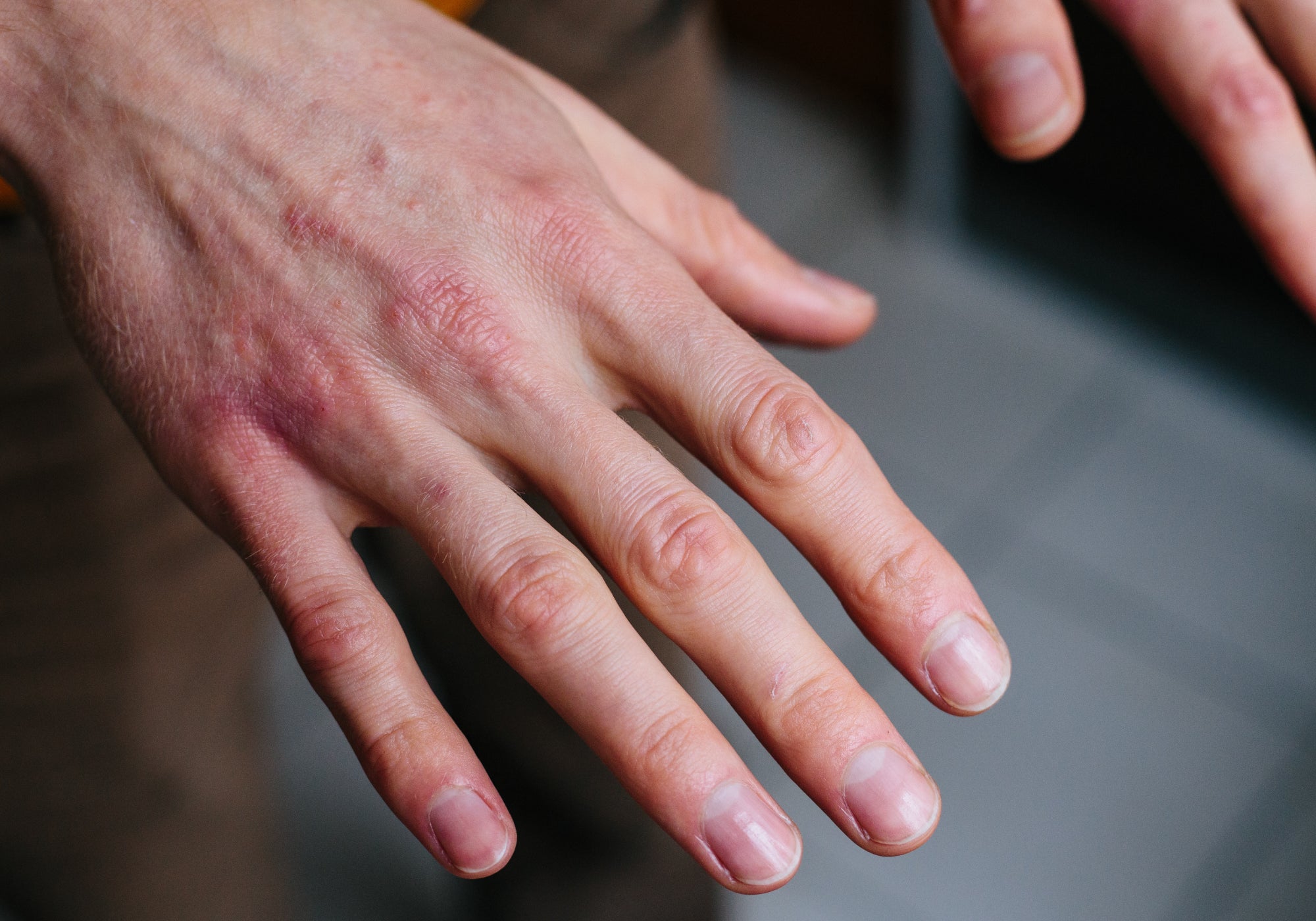 Best Natural Treatment For Sore, Dry, Cracked Hands