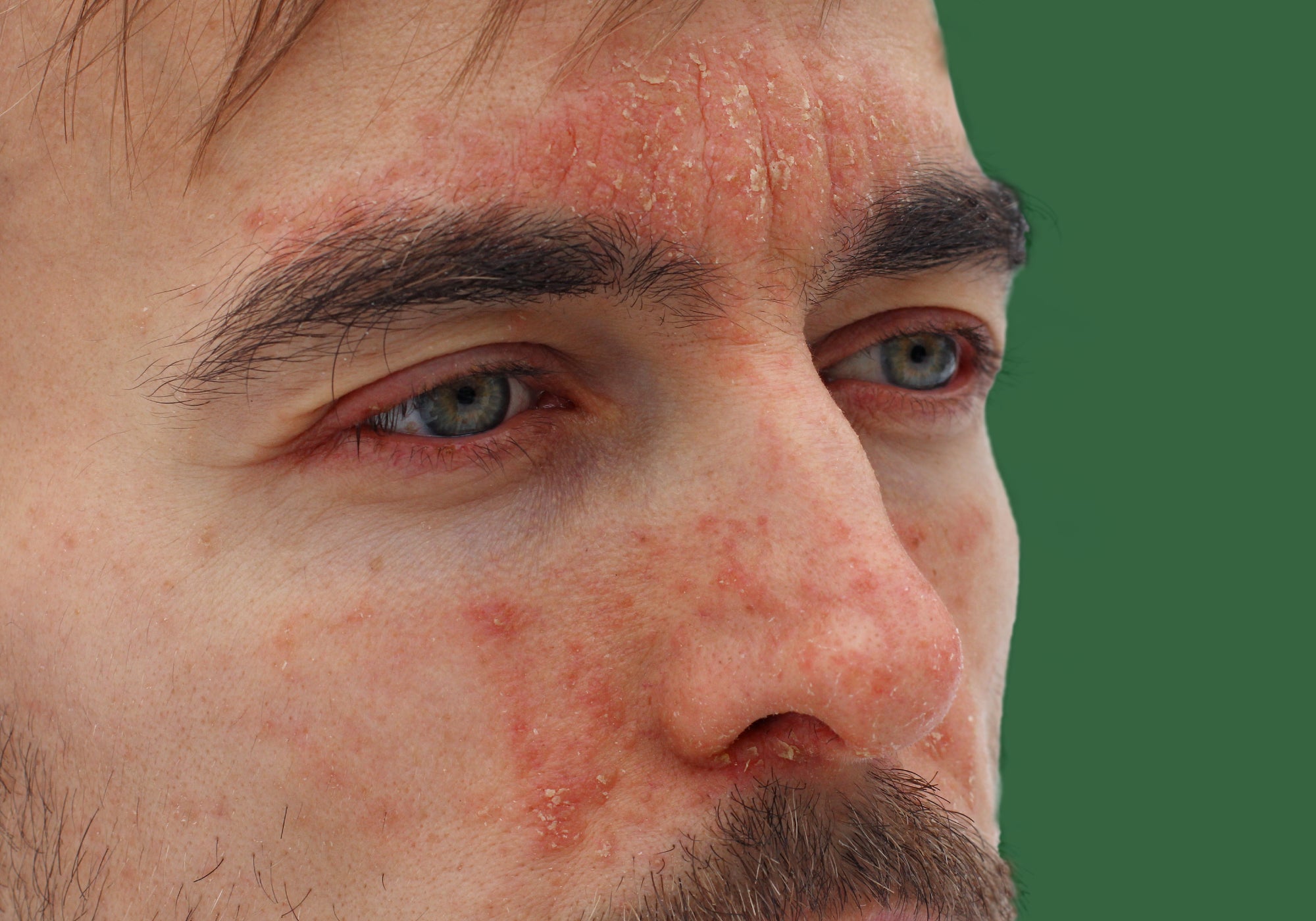 Is Perioral Dermatitis Contagious?