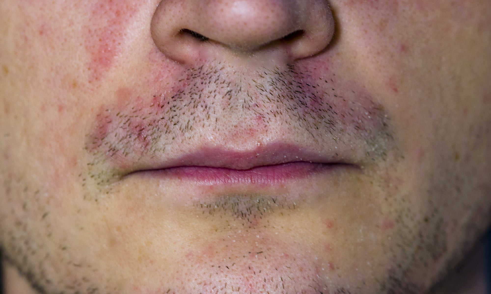 How To Treat Perioral Dermatitis