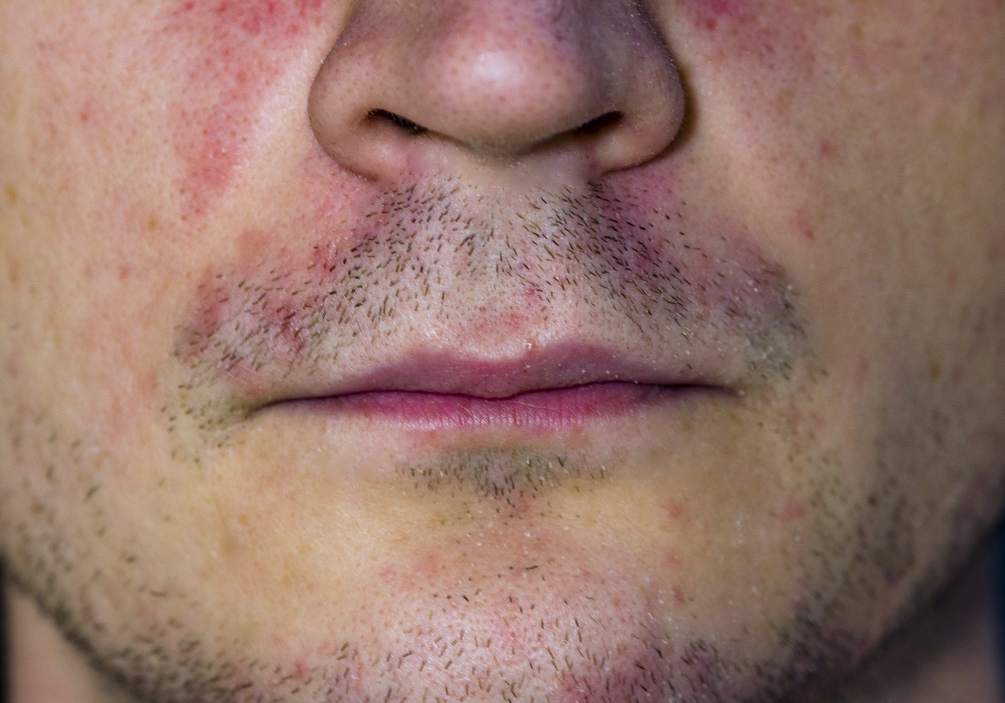 How To Treat Perioral Dermatitis