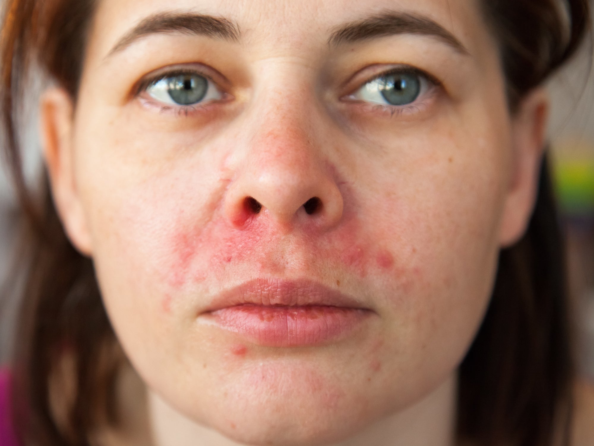 What Is Perioral Dermatitis? Balmonds