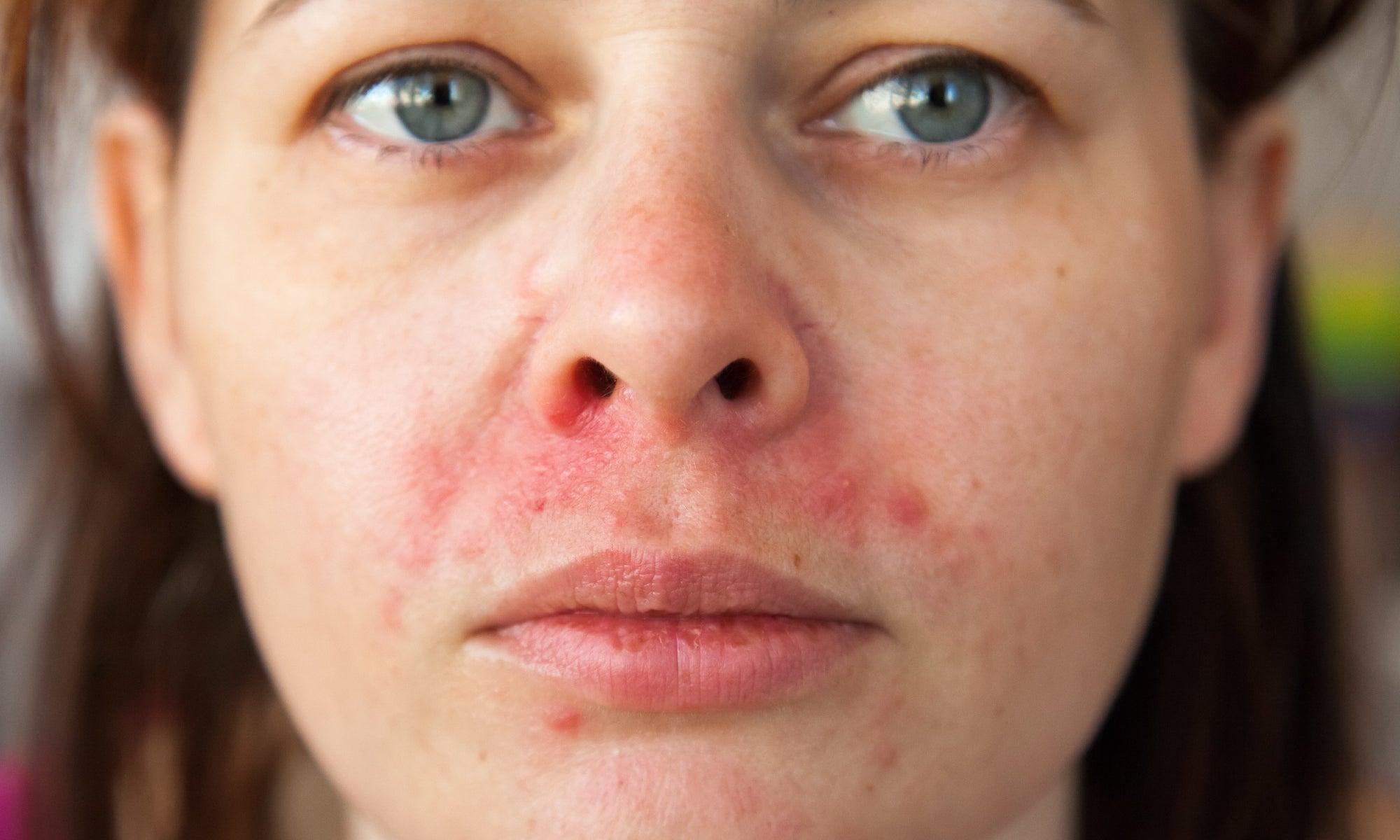 What Is Perioral Dermatitis?