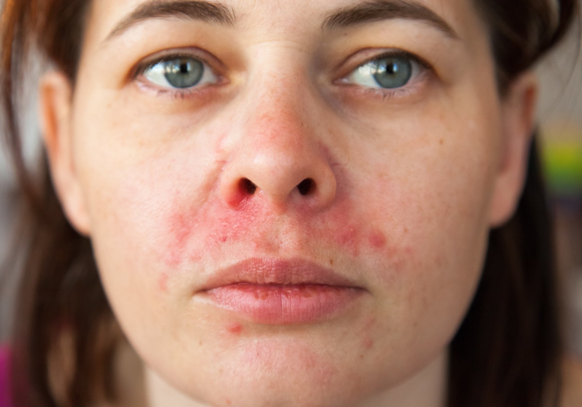 What Is Perioral Dermatitis?