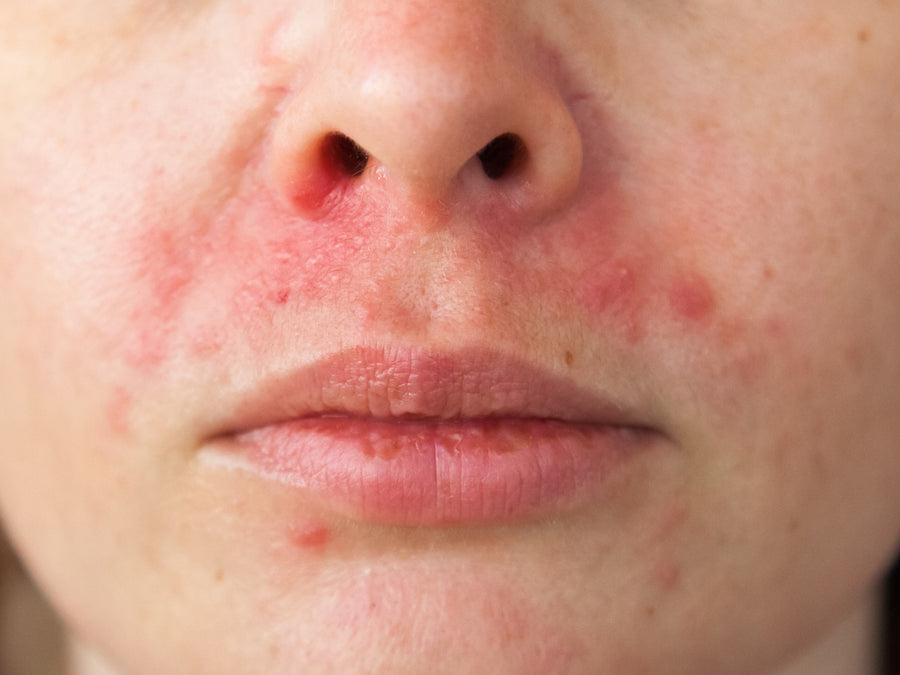 What Home Remedies Are Good For Perioral Dermatitis?