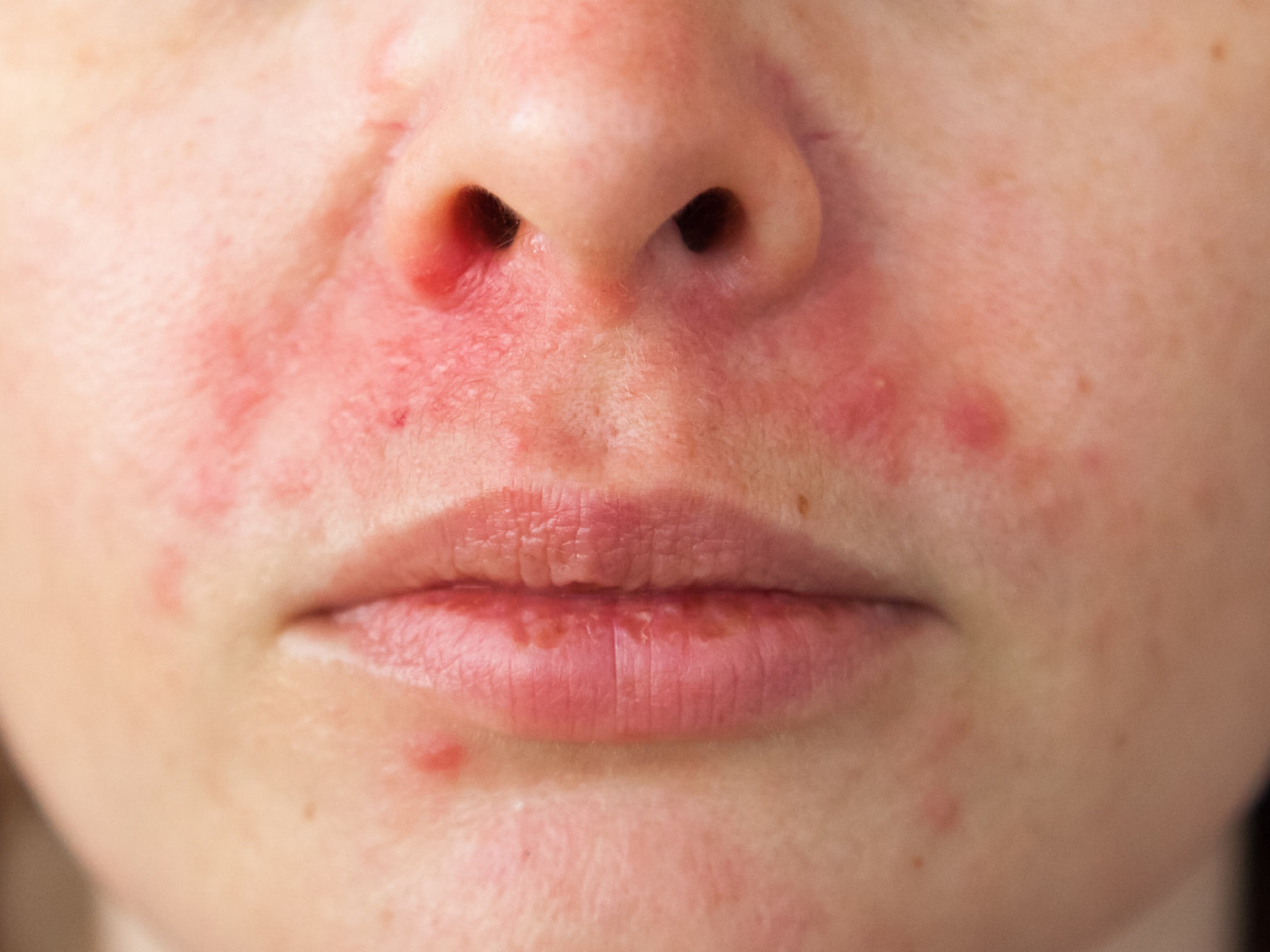 What Home Remedies Are Good For Perioral Dermatitis? Balmonds