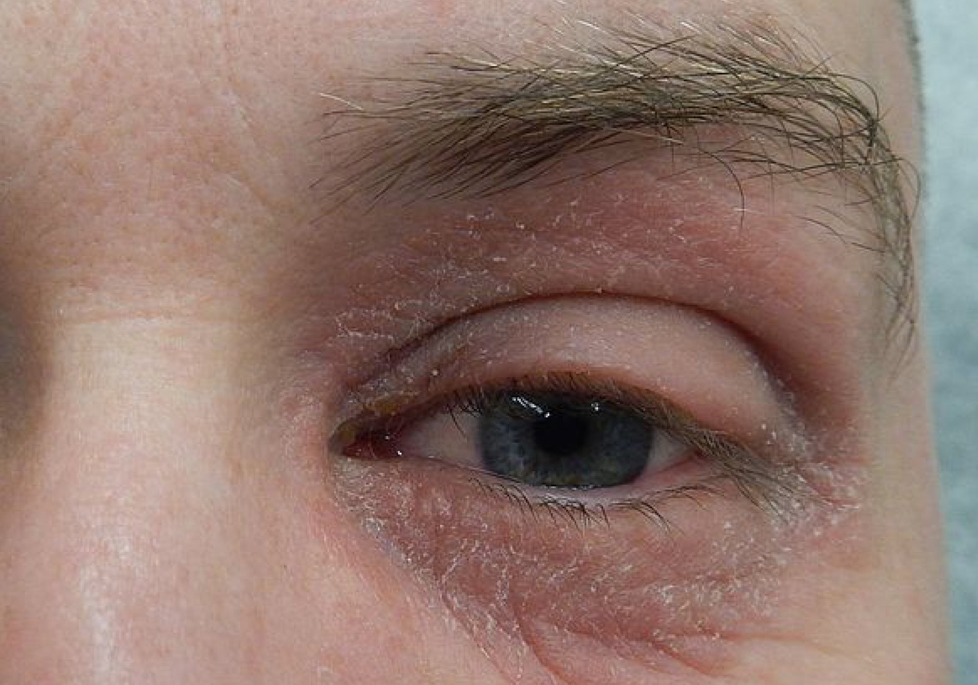 How To Treat Perioral (Periocular) Dermatitis Around The Eyes