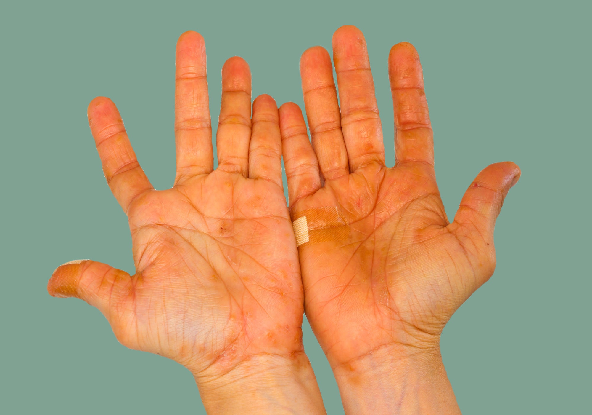 How To Cope With Pompholyx Eczema