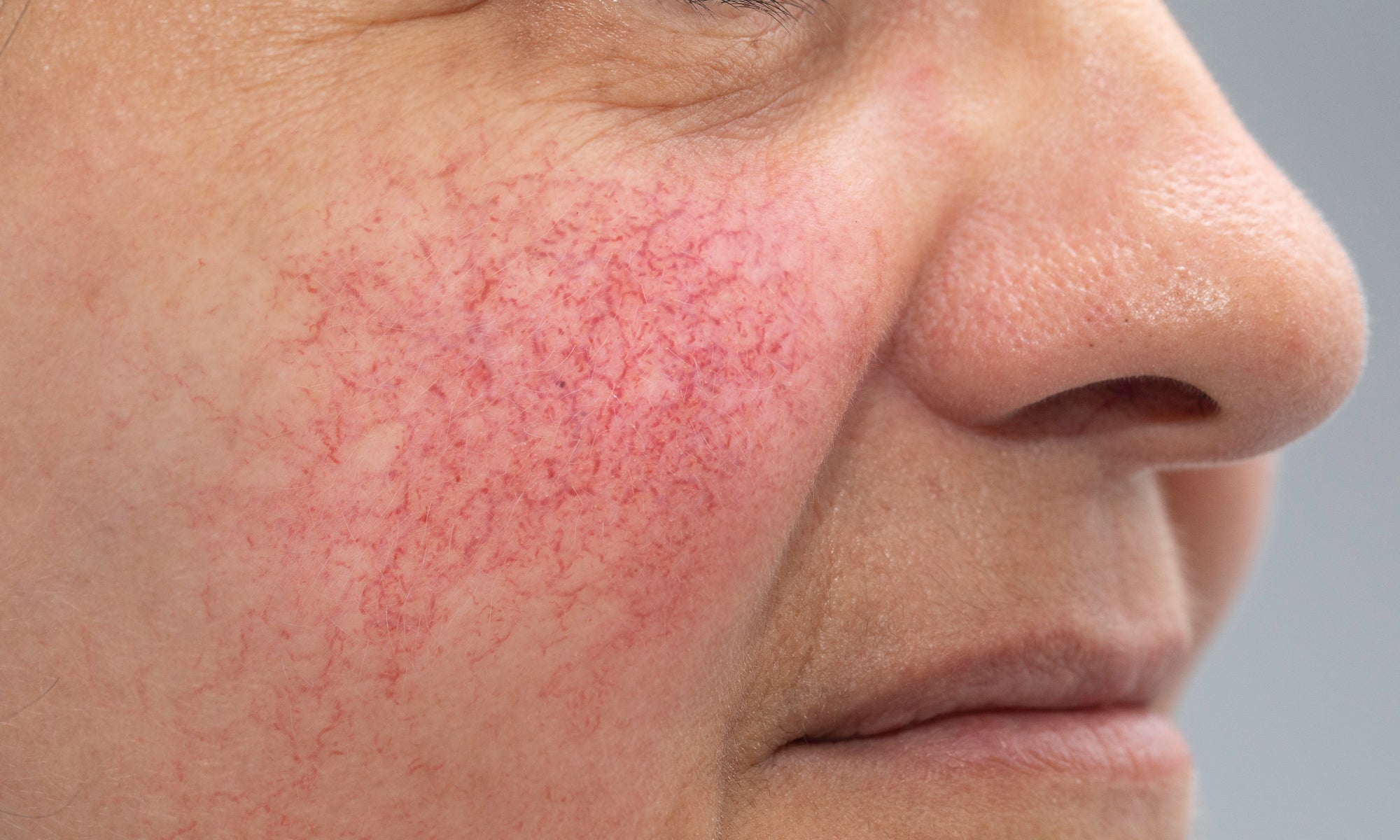 What Happens If Rosacea Is Left Untreated?