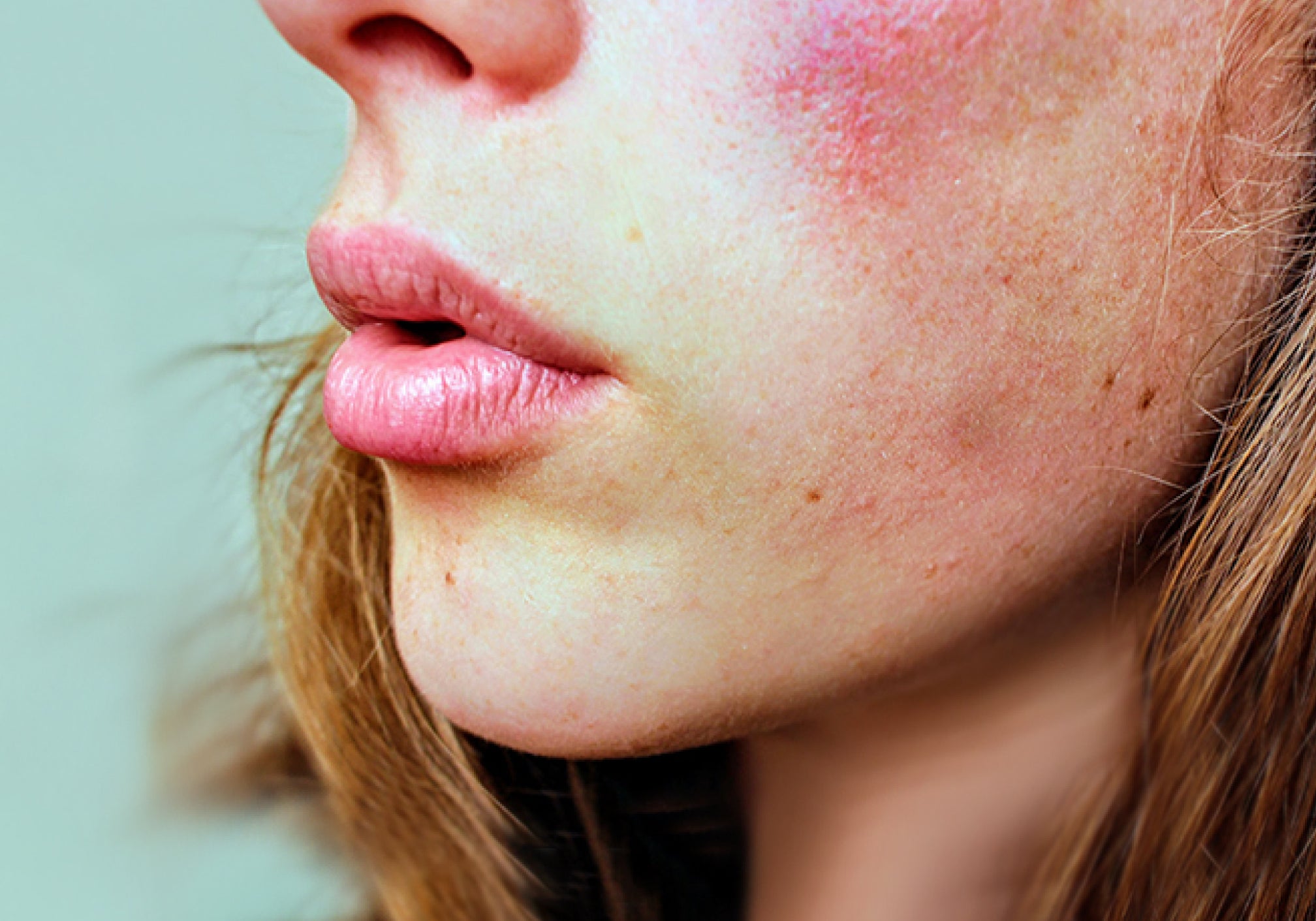 Is It Good To Have a Facial With Rosacea?