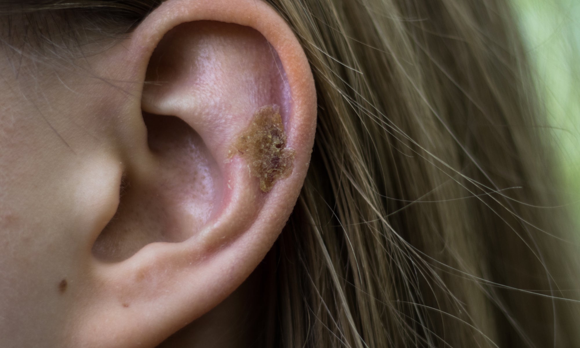 What Causes Scabs In My Ear?