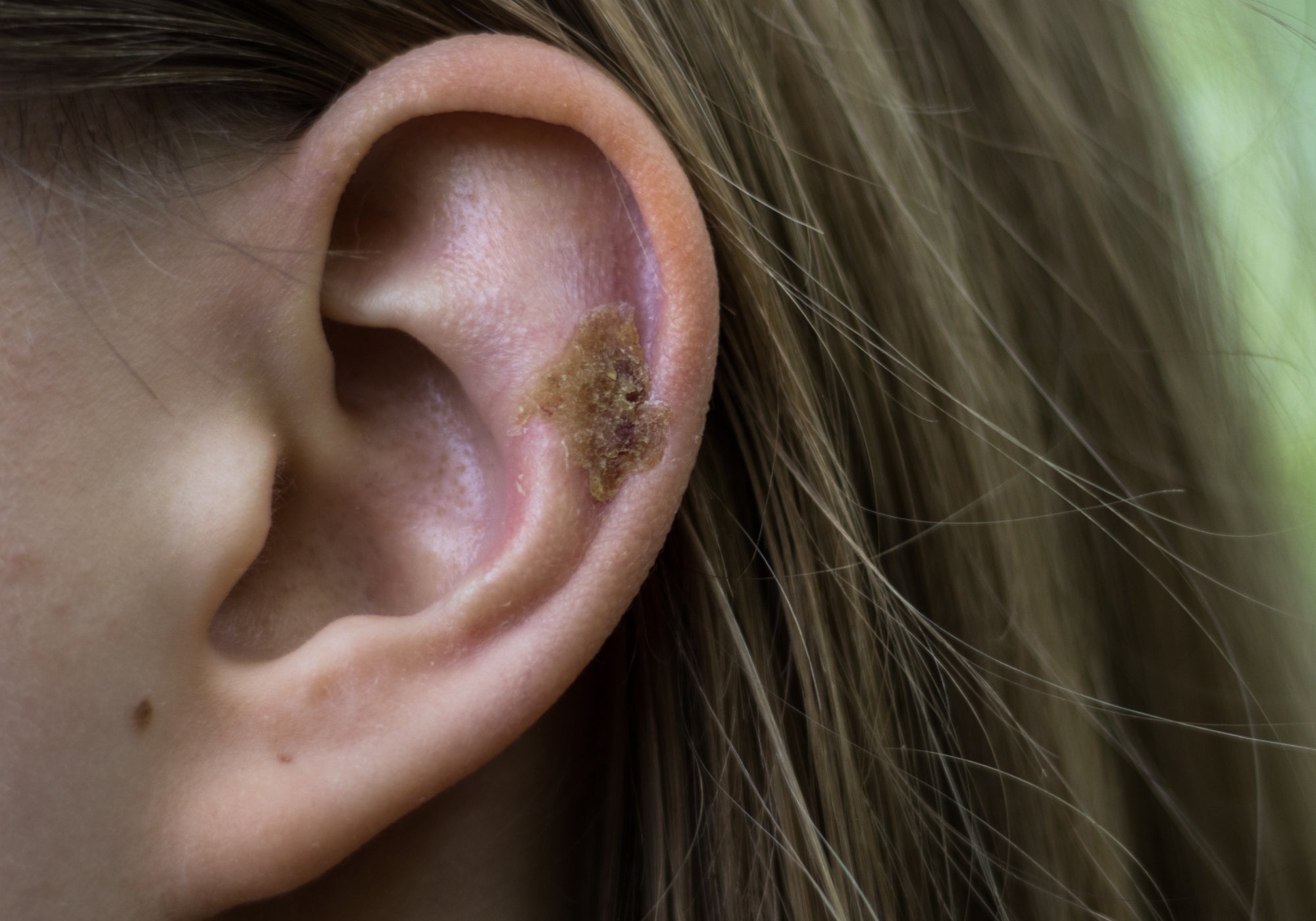 What Causes Scabs In My Ear?
