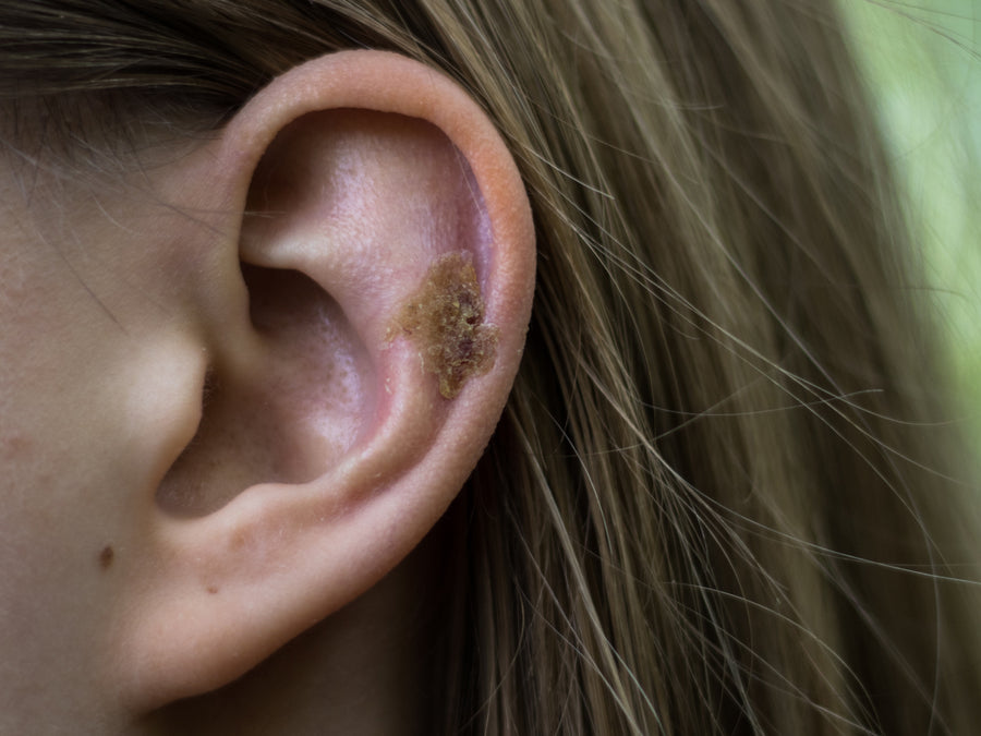 What Causes Scabs In My Ear?