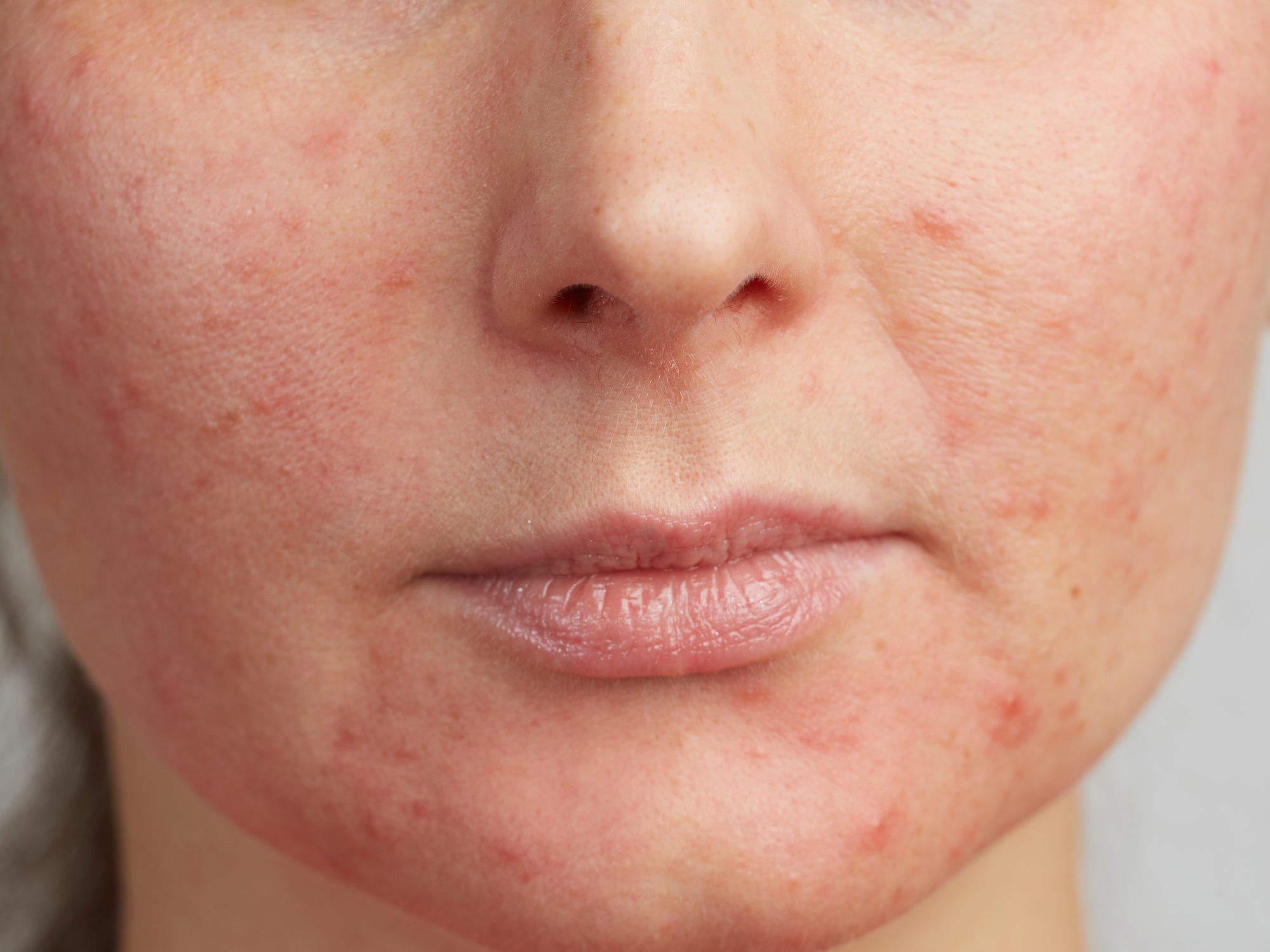 Should You Moisturize Perioral Dermatitis?