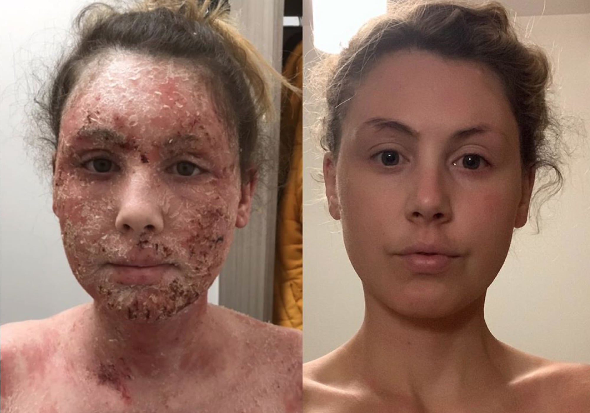 How To Get Through Topical Steroid Withdrawl (TSW): High Pulse Blue Laser