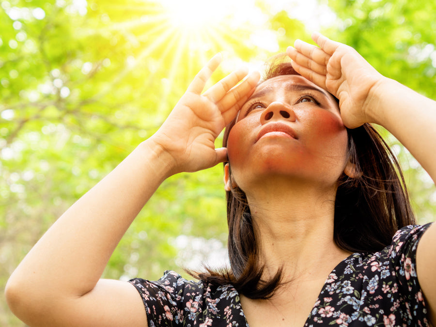 Does Sun Make Perioral Dermatitis Worse?