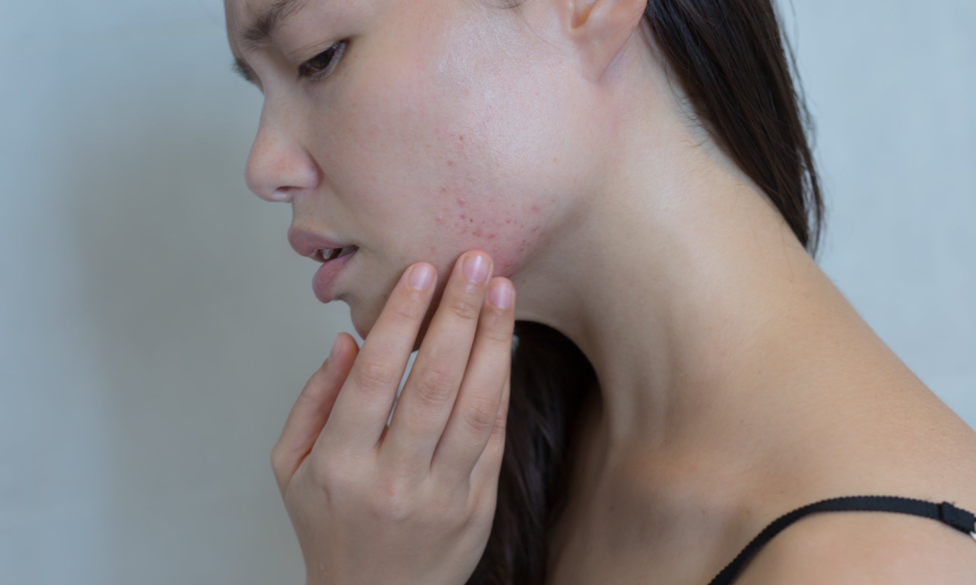 Top 8 Triggers Of Perioral Dermatitis 