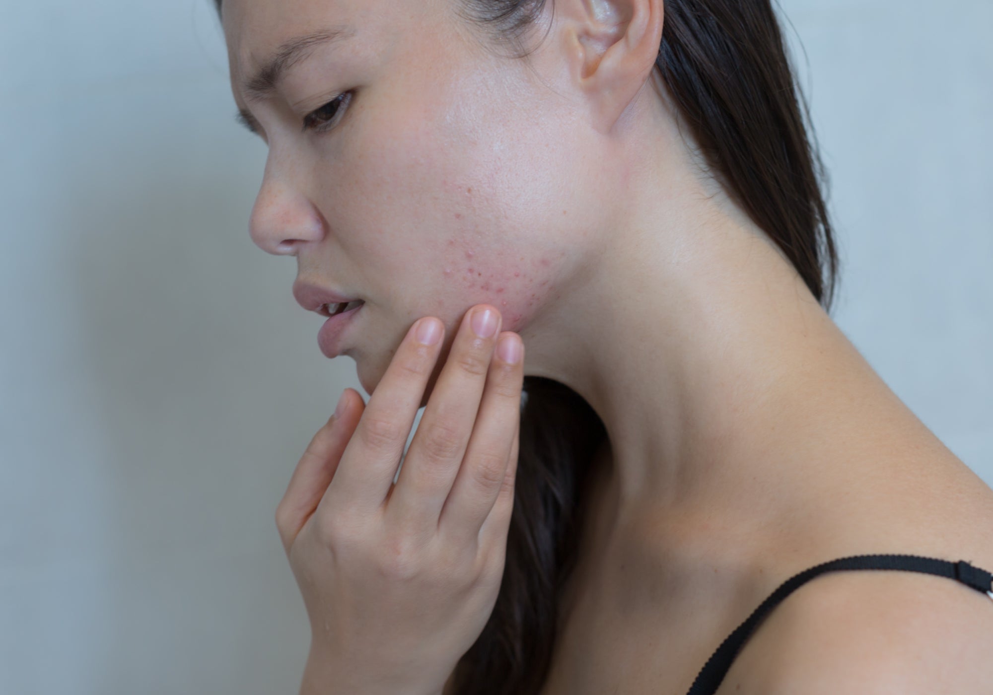 Top 8 Triggers Of Perioral Dermatitis 