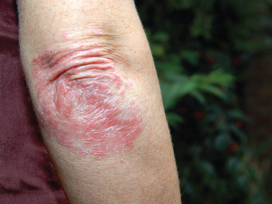What’s The Main Cause Of Psoriasis?
